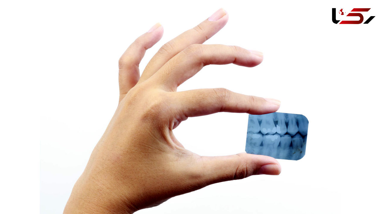 عکس رادیولوژی دندان کمبود ویتامین دی را نشان می دهد