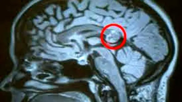 نشانه های هشداردهنده تومور مغزی