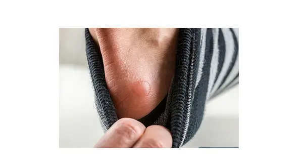 چرا پا تاول می زند؟