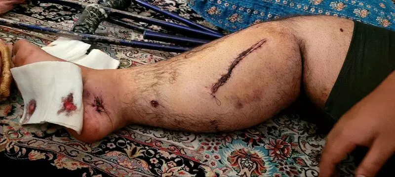 امیرحسین آسیب دیده جنگ