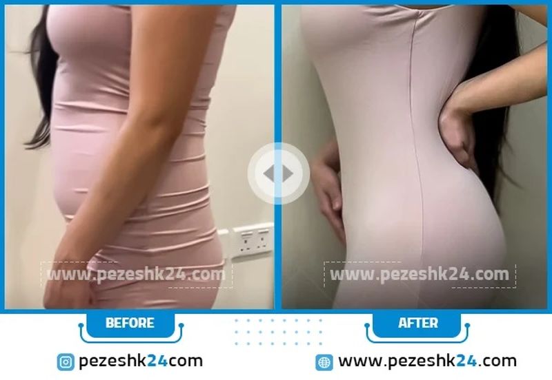 عکس قبل و بعد پیکرتراشی شکم