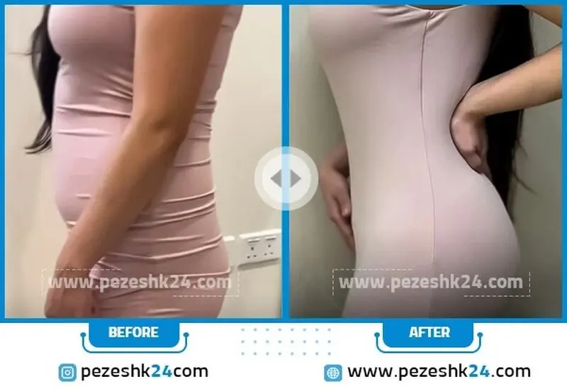 عکس قبل و بعد پیکرتراشی شکم