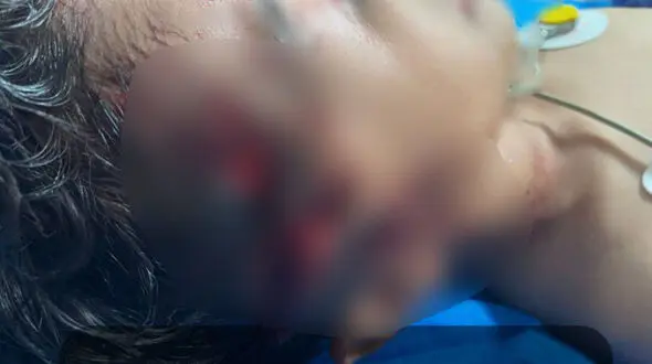 حمله وحشتناک سگ ولگرد به کودک 9 ساله در مریوان