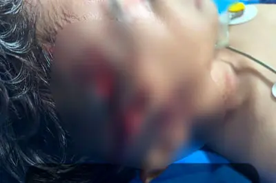 حمله وحشتناک سگ ولگرد به کودک 9 ساله در مریوان