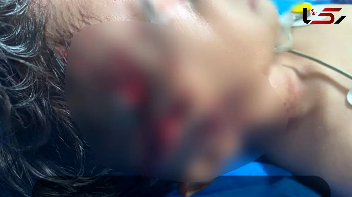 حمله وحشتناک سگ ولگرد به کودک 9 ساله در مریوان