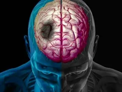 رابطه بین زمستان و سکته مغزی: نکاتی که باید بدانید