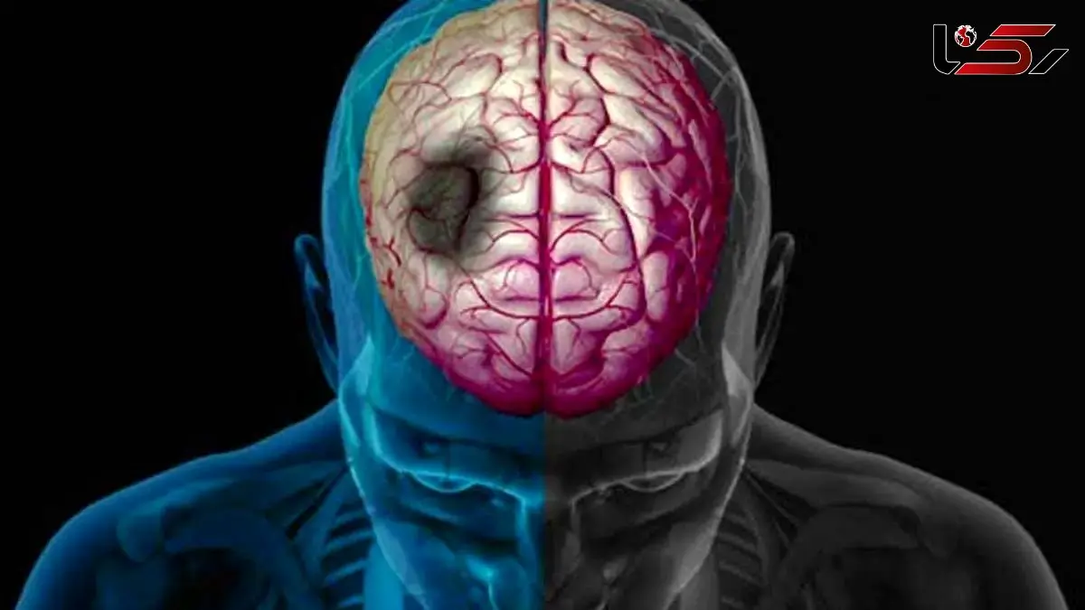 رابطه بین زمستان و سکته مغزی: نکاتی که باید بدانید