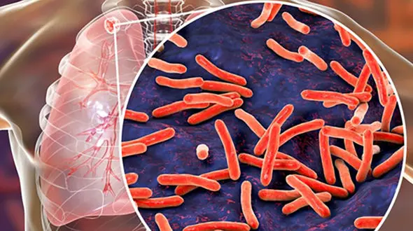 بیماری سل را بیشتر بشناسیم