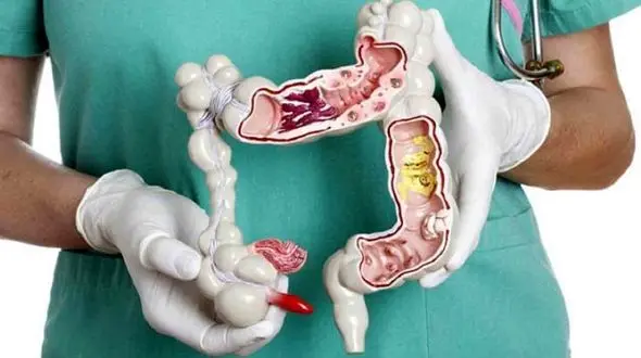 سرطان روده بزرگ در کمین میانسالان