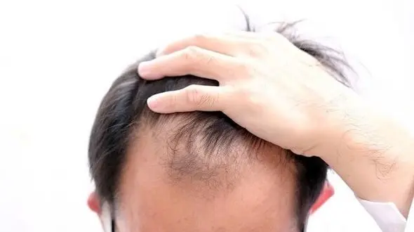 چرا موها دچار ریزش می شود؟ از علل تا درمان