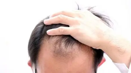 چرا موها دچار ریزش می شود؟ از علل تا درمان