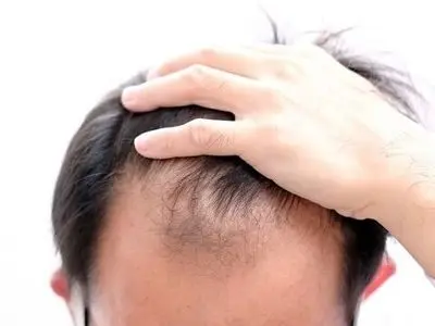 چرا موها دچار ریزش می شود؟ از علل تا درمان