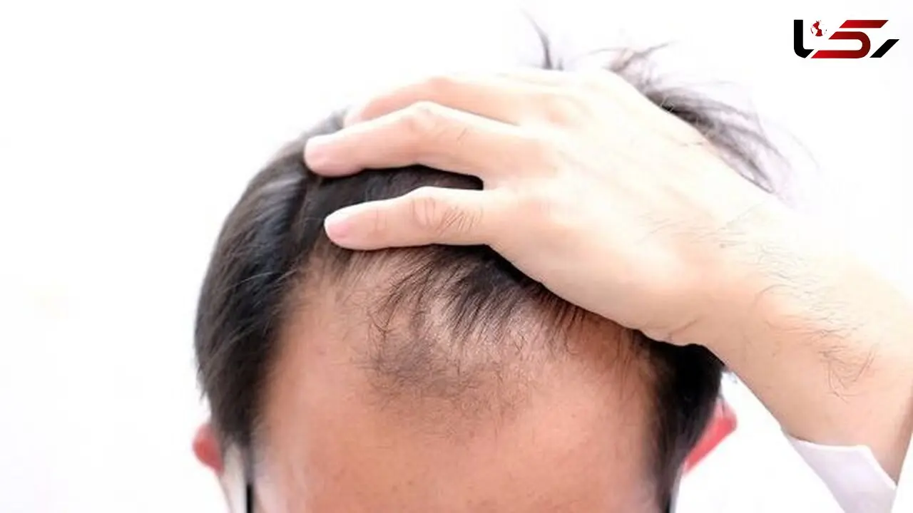 چرا موها دچار ریزش می شود؟ از علل تا درمان