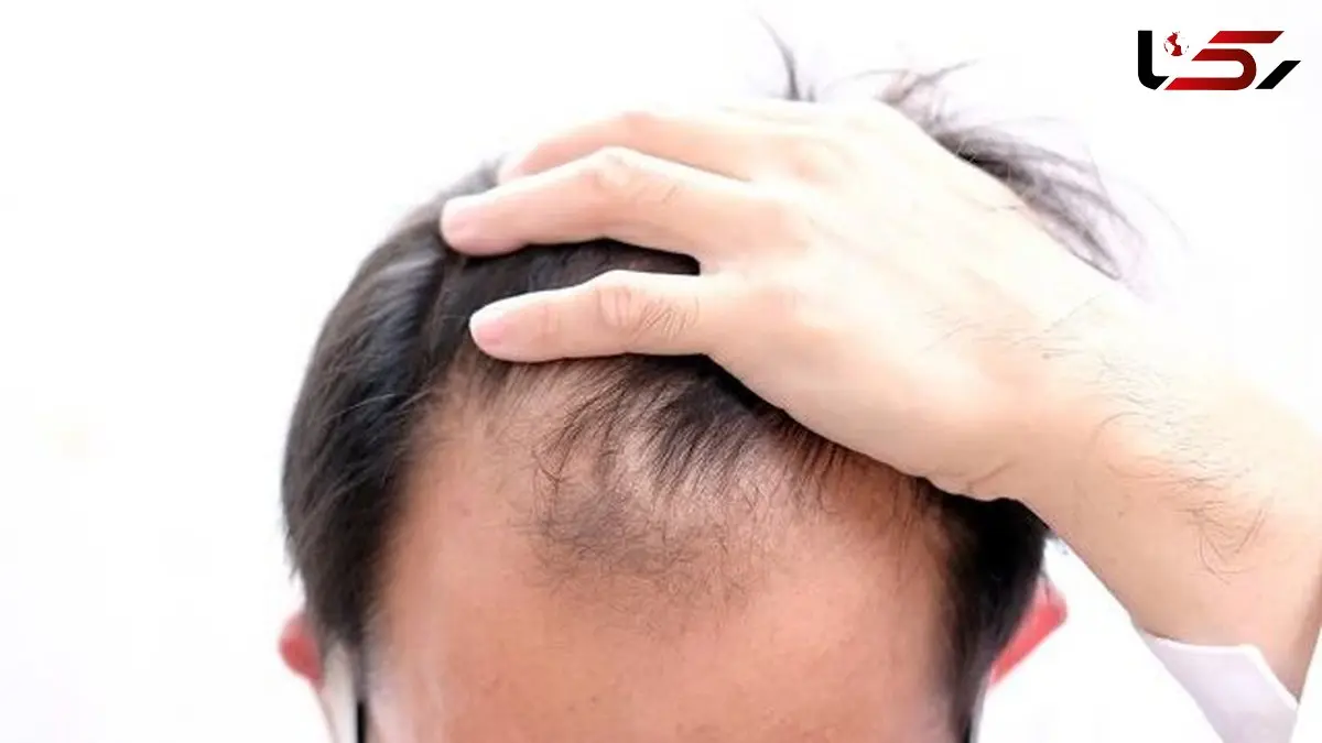 چرا موها دچار ریزش می شود؟ از علل تا درمان