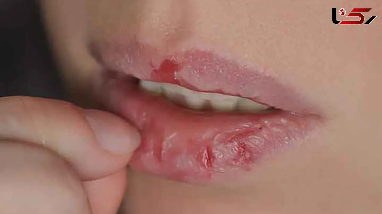چطور عادت کندن پوست لب را ترک کنیم؟