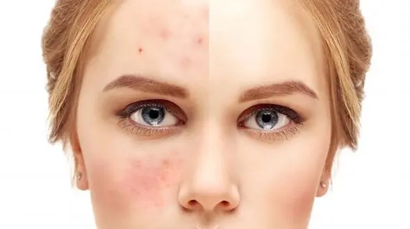 پوست چرب و دارای جوش‌ را در خانه پاکسازی کنید