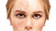 پوست چرب و دارای جوش‌ را در خانه پاکسازی کنید
