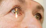 آب مروارید چیست؟ / راهکارهای پیشگیری از آب مروارید + جدول