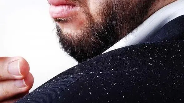 درمان فوری شوره سر با ساده ترین ترفندها