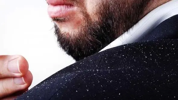 درمان فوری شوره سر با ساده ترین ترفندها