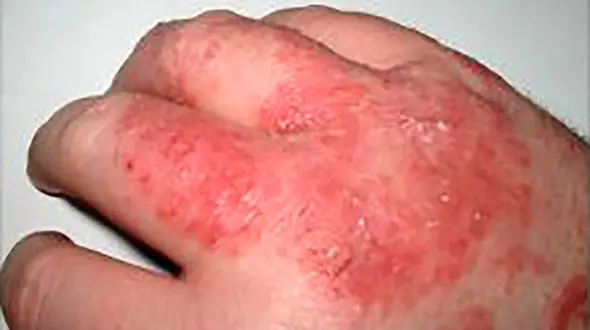 سالانه ۱۱ میلیون نفر در جهان بر اثر ابتلا به « سپسیس» می میرند