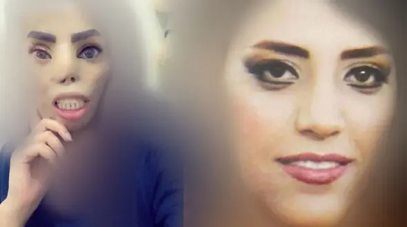قربانی اسیدپاشی مدل عروس شد / هنوز برای رسیدن به هدف هایم میجنگم + فیلم