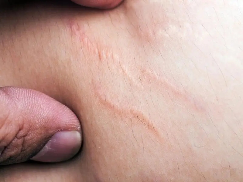 اسکار پوستی