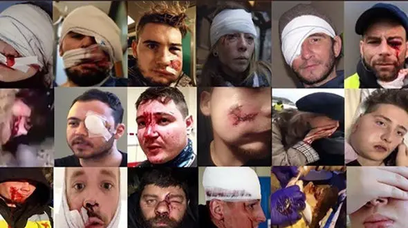 کور شدن معترضان خیابانی / از دست دادن چشم بهای اعتراض+ عکس چشم های معترضان
