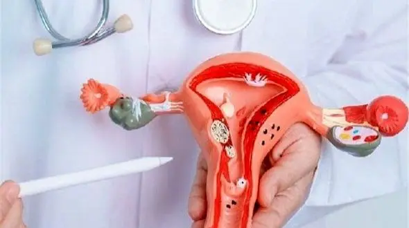 یک زن از هر 10 نفر دچار آندومتریوز می‌شود