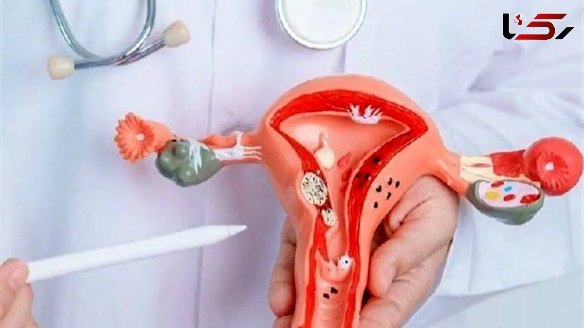 یک زن از هر 10 نفر دچار آندومتریوز می‌شود