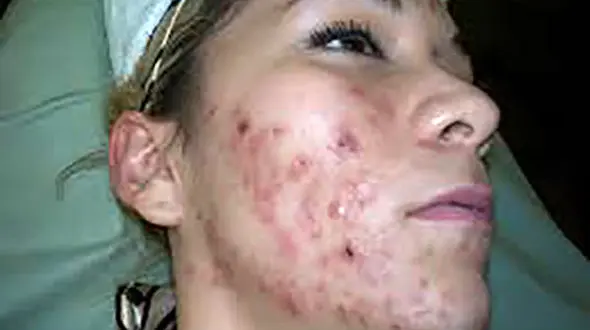 زن امریکایی ادرار سگ خورد تا آکنه صورتش درمان شود!  +عکس