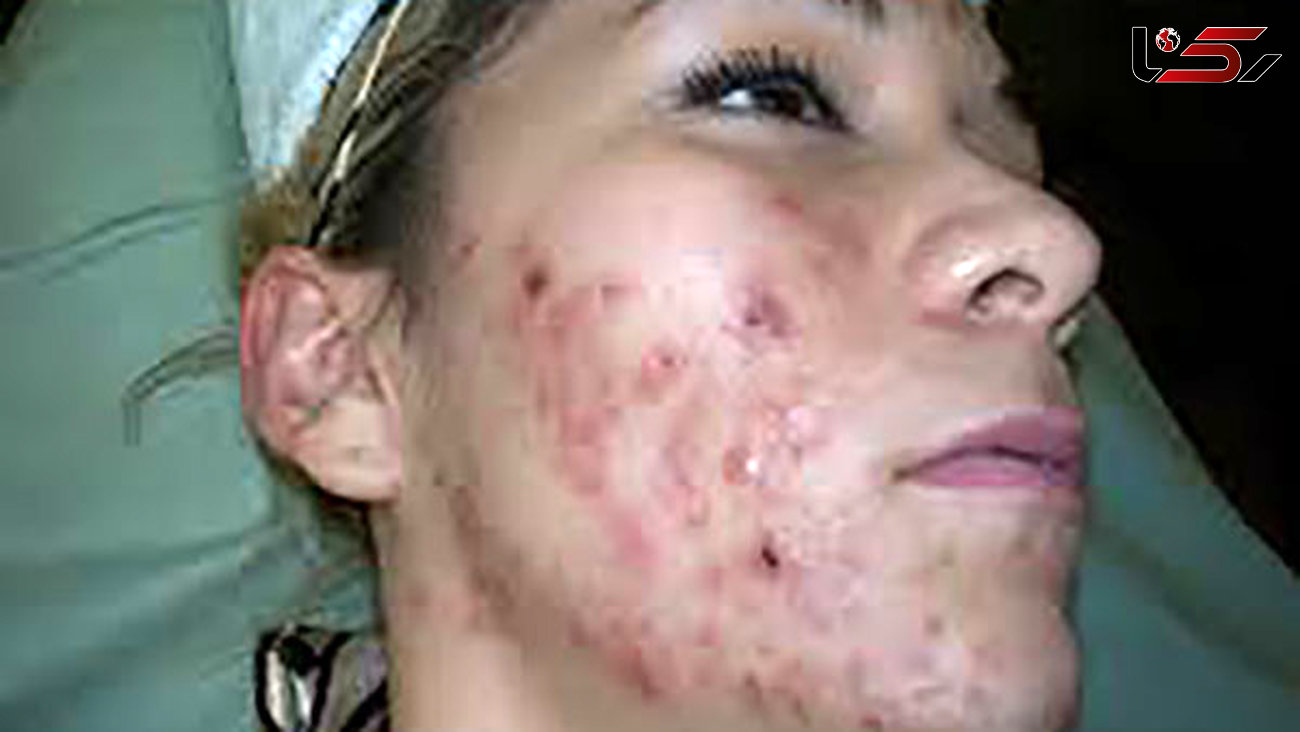 زن امریکایی ادرار سگ خورد تا آکنه صورتش درمان شود!  +عکس