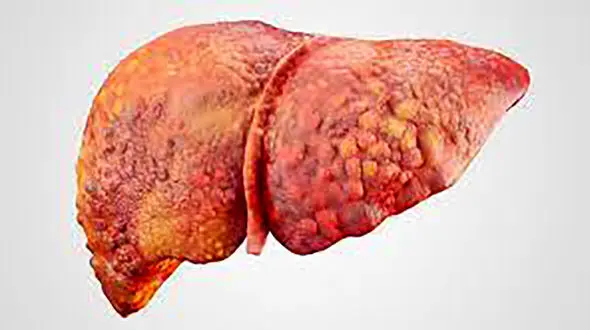 نکات طلایی درمان کبد چرب