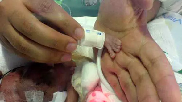 فسقلی ترین نوزاد دنیا در 5 ماهگی متولد شد+عکس