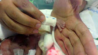 فسقلی ترین نوزاد دنیا در 5 ماهگی متولد شد+عکس