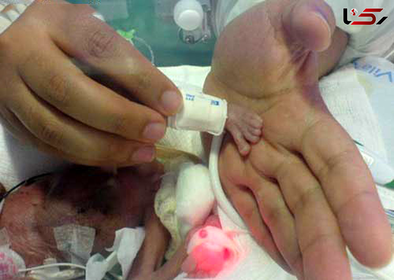 فسقلی ترین نوزاد دنیا در 5 ماهگی متولد شد+عکس
