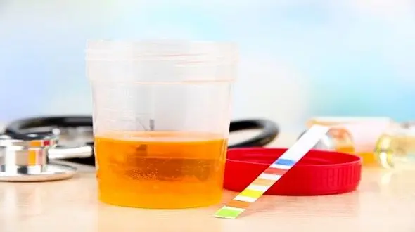 آقایان ادرار خونی را جدی بگیرند