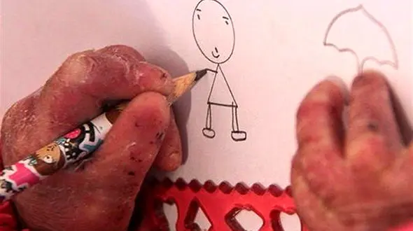 تاول های بدن بهاره 6 ساله تمامی ندارد! + عکس های دلخراش