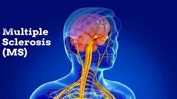 ام اس درمان می شود 