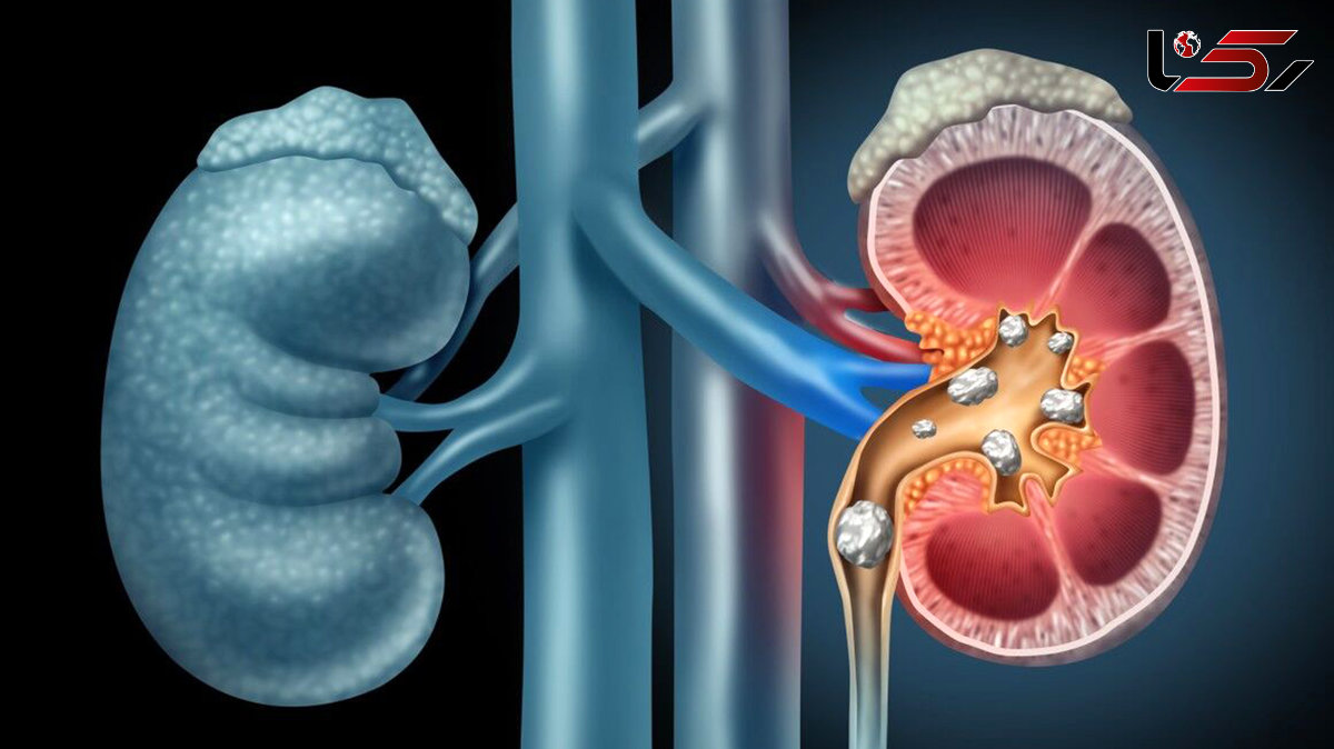 ۶.۶ درصد ایرانی‌ها سنگ کلیه دارند ! / آمار کدام استان بیشتر است؟
