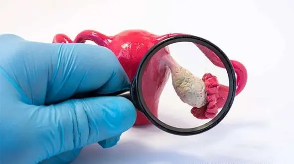 کیست تخمدان چیست؟