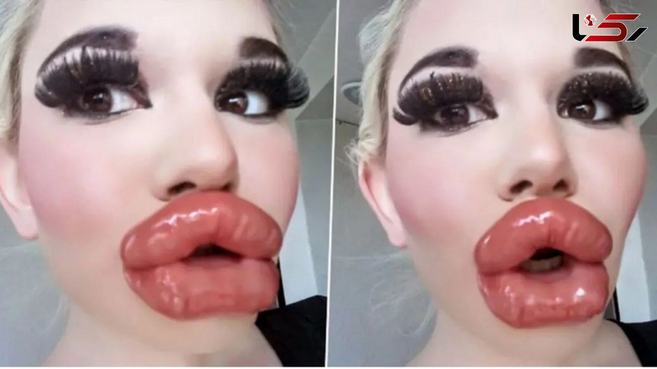 زشت ترین خانم باربی جهان با  پروتز لب / خانم لب شتری را ببینید ! + عکس ها قبل و بعد جراحی زیبایی