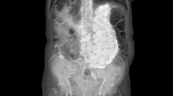 معده مرد 45 ساله پر از سنگ بود !+عکس