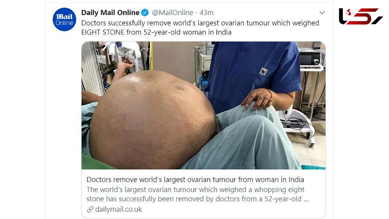 خارج کردن بزرگترین تومور تخمدان از شکم یک زن 52 ساله + عکس
