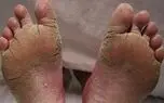 چرا کف پا پوسته پوسته می شود؟ / پرسش و پاسخ درباره پوسته‌ پوسته شدن کف پا 