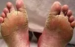 چرا کف پا پوسته پوسته می شود؟ / پرسش و پاسخ درباره پوسته‌ پوسته شدن کف پا 