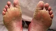 چرا کف پا پوسته پوسته می شود؟ / پرسش و پاسخ درباره پوسته‌ پوسته شدن کف پا 