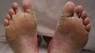 چرا کف پا پوسته پوسته می شود؟ / پرسش و پاسخ درباره پوسته‌ پوسته شدن کف پا 