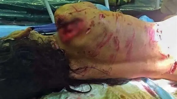 سرنوشت دختر بچه لت و پار شده توسط سگ ولگرد وحشتناک است + عکس