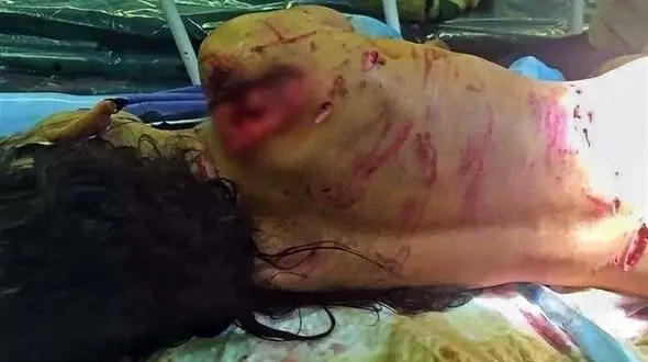 سرنوشت دختر بچه لت و پار شده توسط سگ ولگرد وحشتناک است + عکس